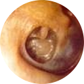 Grommets — Mr Daniel Tweedie - Consultant Paediatric ENT Surgeon, London